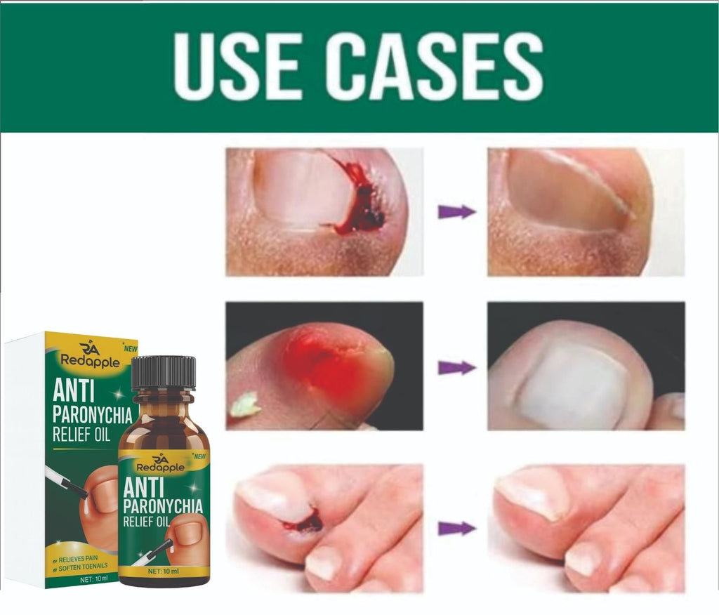Anti Paronychia Relief Oil 20 ml Pack of 2